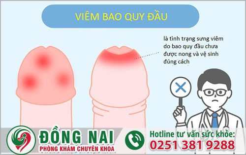 Bao nhiêu giai đoạn về tình trạng viêm bao quy đầu ở phái mạnh?