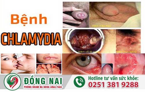 Bệnh Chlamydia gây nhiều biến chứng nguy hiểm cho người bệnh