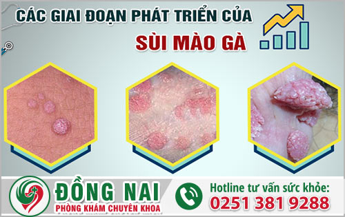 Tiến triển của bệnh sùi mào gà như thế nào?