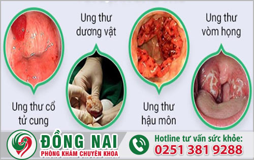 Bệnh sùi mào gà có gây ung thư không?