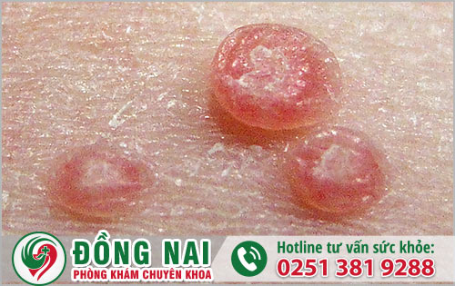 Mụn dương vật ở nam giới không nên xem thường