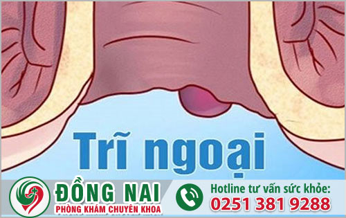 Trĩ ngoại và nguyên nhân gây bệnh