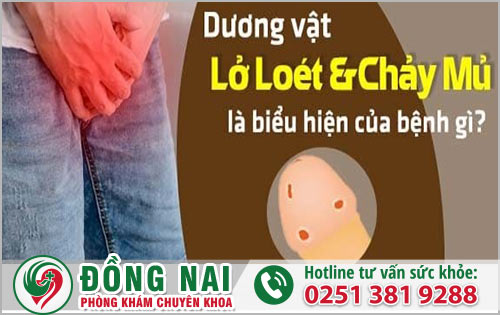 Dương vật vật lở loét chảy mủ biểu hiện nhiều bệnh lý nguy hiểm