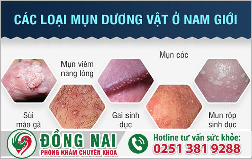 Cậu bé nổi mụn ở nam giới có thể xuất phát từ nguyên nhân gì?