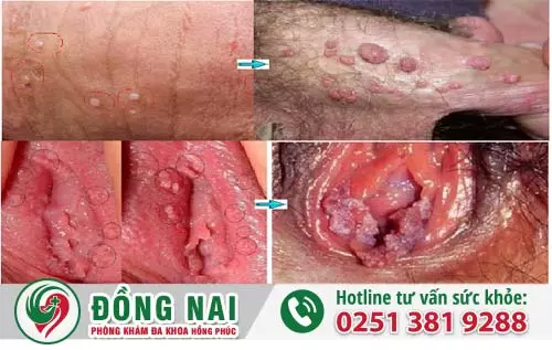 Hình ảnh sùi mào gà nam nữ