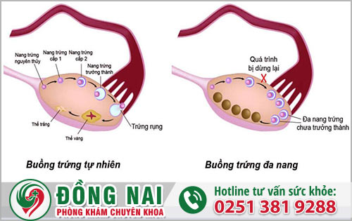 Chữa buồng trứng đa nang bằng OvaQ1 có con được không?