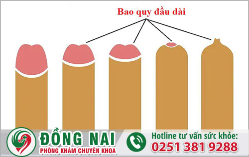 Có mấy dạng về tình trạng bao quy đầu dài?