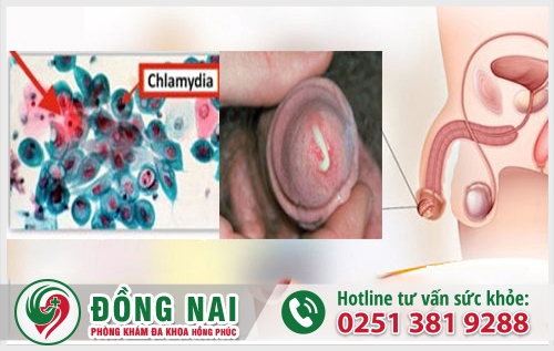 Dấu hiệu bệnh Chlamydia ở nam giới