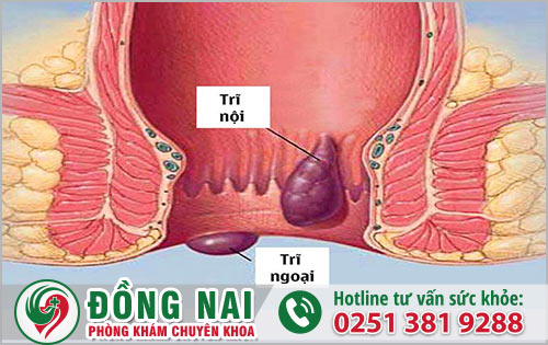 Dấu hiệu bệnh trĩ nhẹ là thế nào?