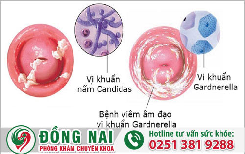 Dấu hiệu sức khỏe phụ khoa nguy hiểm khi bị viêm loét âm đạo
