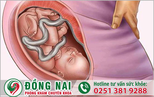 Dây rốn thắt nút có ảnh hưởng gì không?