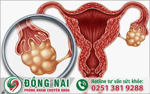 Địa chỉ chữa trị nang buồng trứng uy tín tại Biên Hòa Đồng Nai?