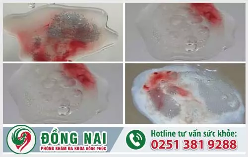Địa chỉ chữa xuất tinh ra máu ở Biên Hòa, Đồng Nai an toàn?