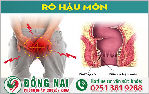 Tại sao cần điều trị bệnh rò hậu môn?