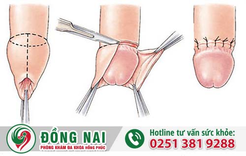 Cắt bao quy đầu giúp nam giới giảm nguy cơ mắc các bệnh lý nam khoa