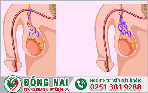 Điều nguy hại nào khi nam giới bị viêm tinh hoàn quai bị?