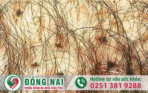 Địa chỉ phòng khám chữa rận lông mu ở Biên Hòa Đồng Nai
