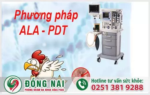 Đốt điện sùi mào gà phương pháp ALA-PDT