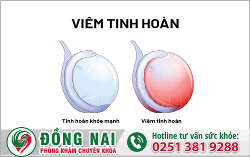 Giảm chi phí chữa bệnh tinh hoàn khi đặt hẹn khám online