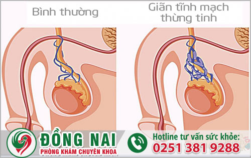 Giãn tĩnh mạch thừng tinh gây rối loạn cương dương