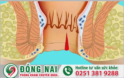 Hỗ trợ khắc phục bệnh trĩ ngoại với công nghệ tiên tiến hiện nay