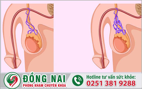 Biến chứng từ hoại tử tinh hoàn do bị xoắn tinh hoàn?