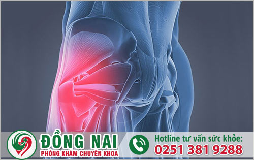 Hội chứng cơ nâng hậu môn là bệnh gì?