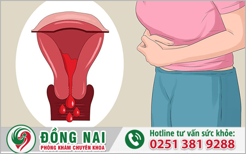 Lạc nội mạc tử cung gây ung thư, vô sinh ở nữ giới