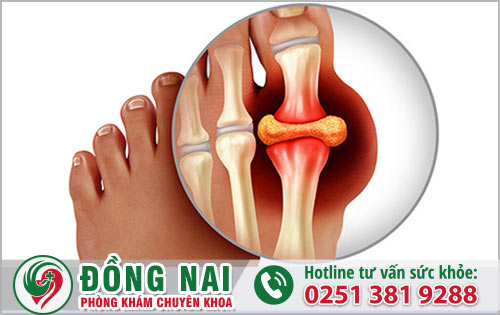 Một số loại thực phẩm người bị gout cần tránh?