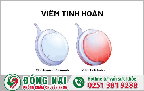 Nam giới bị đau sưng tinh hoàn cảnh báo bệnh nguy hiểm nào?