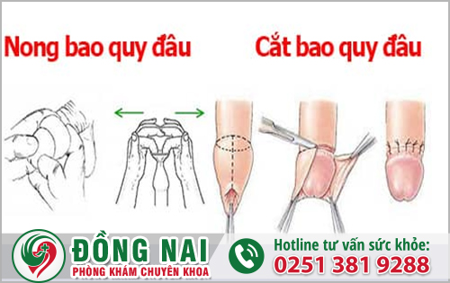 Làm sao để bao quy đầu chưa lột mà quan hệ được?