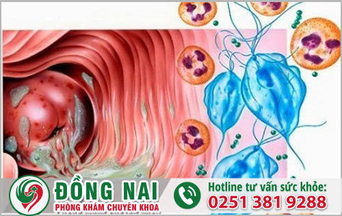 Nguy cơ nào dẫn đến nhiễm trùng Trichomonas ở âm đạo?