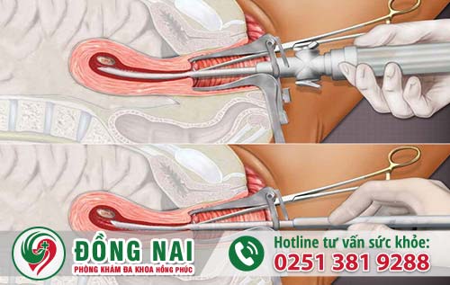 Những cách phá thai dân gian an toàn, hiệu quả nhất