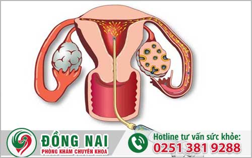 Hình ảnh bơm tinh trùng vào buồng tử cung (hình 1)