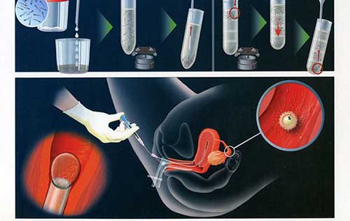 Hình ảnh bơm tinh trùng vào buồng tử cung (hình 2)