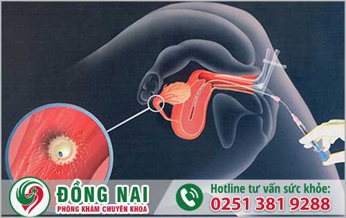 Hình ảnh bơm tinh trùng vào buồng tử cung (hình 4)