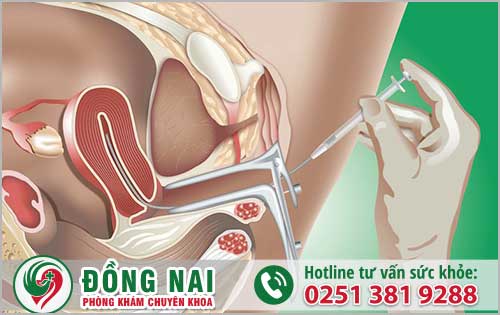 Hình ảnh bơm tinh trùng vào buồng tử cung (hình 5)