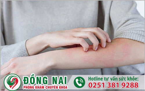 Những nguyên nhân nào dẫn đến nổi mề đay