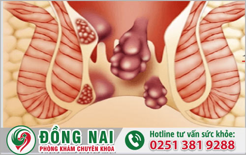 Phát hoảng vì đại tiện ra máu nhưng không rõ nguyên nhân?