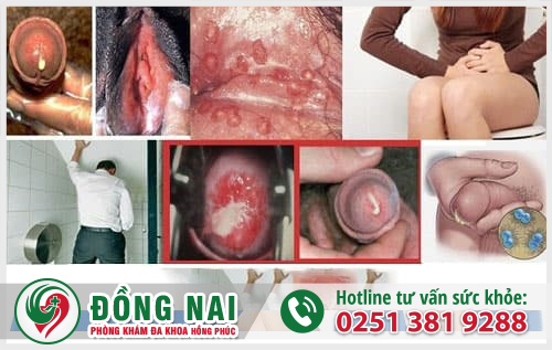 Hình ảnh nhận biết bệnh lậu