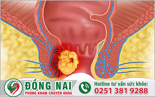 Polyp hậu môn và các triệu chứng cảnh báo bệnh nguy hiểm cần biết?