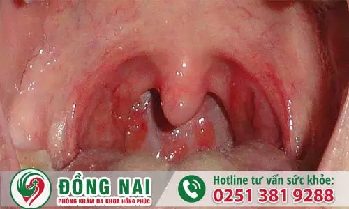 Tổng hợp hình ảnh bệnh sùi mào gà ở miệng - vị trí Amidan