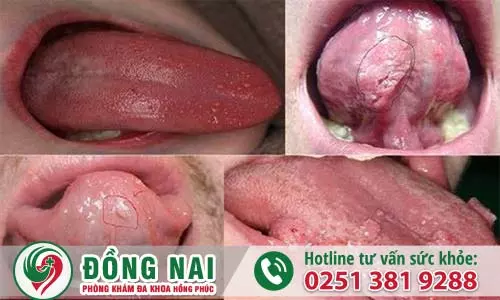 Hình ảnh bệnh sùi mào gà ở nam chi tiết (hình 5)