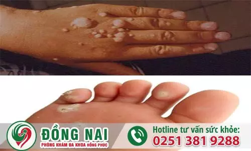 Hình ảnh bệnh sùi mào gà ở nam chi tiết (hình 3)