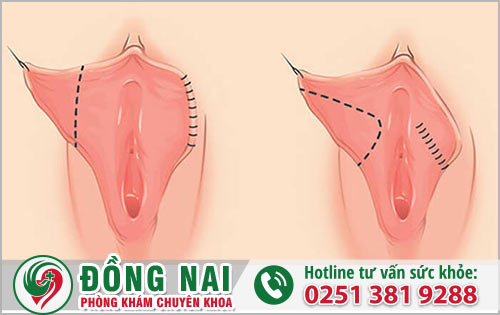 Thu nhỏ âm đạo với phương pháp nào hiệu quả hiện nay?