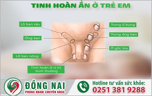 Tinh hoàn ẩn ở trẻ em 