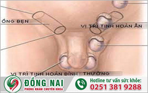 Tinh hoàn bị ẩn