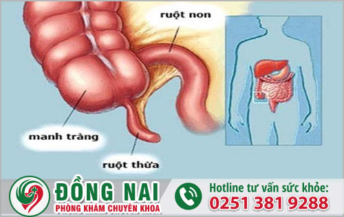 Tình trạng đau ruột thừa khi mắc phải sẽ có biểu hiện ra sao?