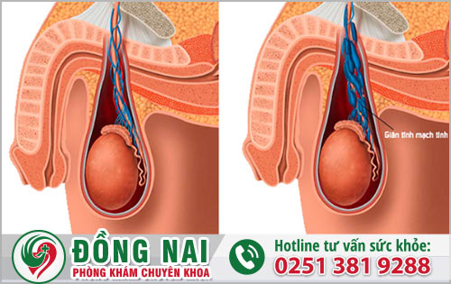 Top 4 nguyên nhân dẫn đến hiện trạng tinh hoàn bị sưng