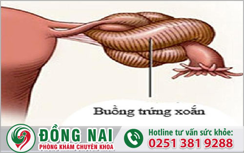 Triệu chứng cảnh báo nguy hiểm từ xoắn buồng trứng cần biết